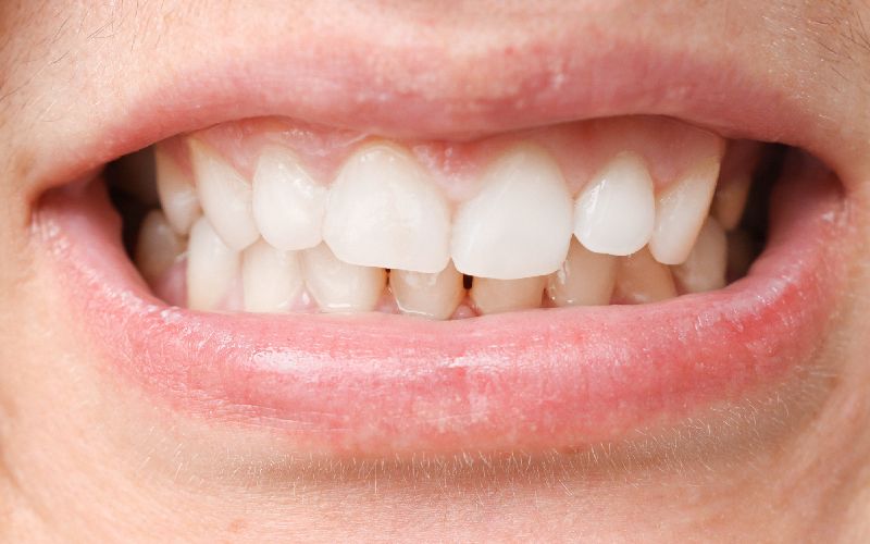 mouth white teeth malocclusion health problem