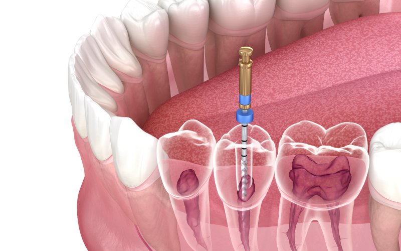 endodontic root canal treatment process medically accurate tooth illustration
