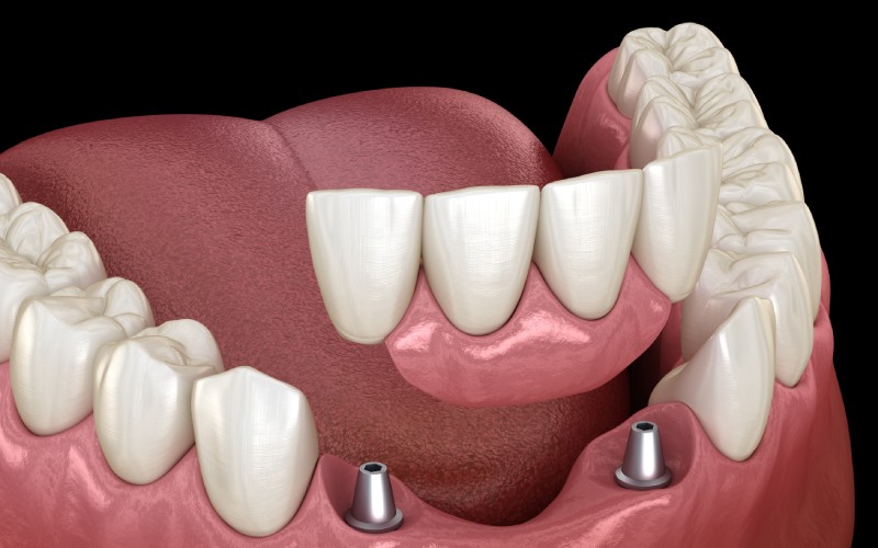 frontal teeth bridge supported implants medically accurate animation dental concept